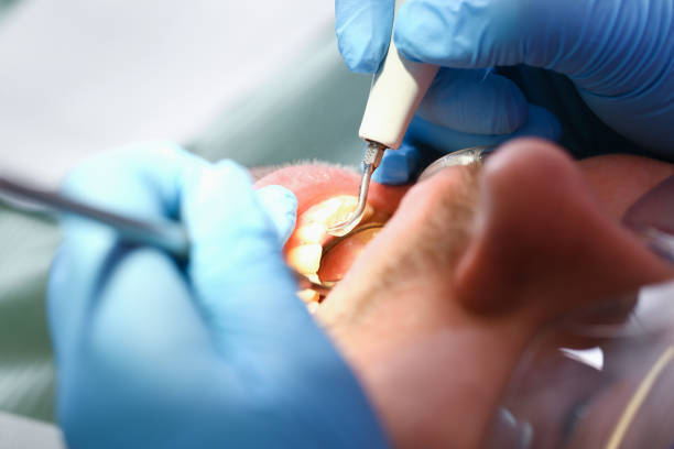 Best Emergency Dental Care for Sports Injuries in Osceola Mills, PA